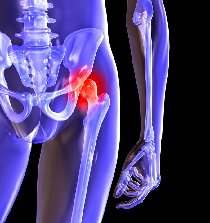 Deforming arthrosis ng hip joint