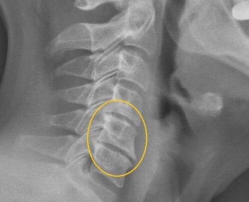 Osteochondrosis ng cervical spine sa isang x -ray