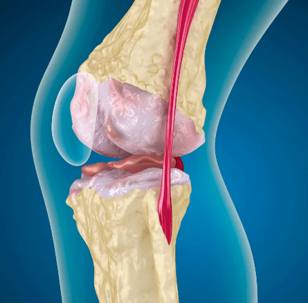 Arthrososis ng kasukasuan ng tuhod