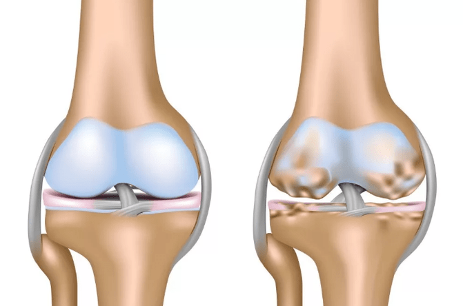 Deforming arthrosis ng kasukasuan ng tuhod