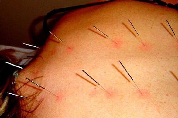 Acupuncture - Isang paraan ng pagpapagamot ng cervical osteochondrosis