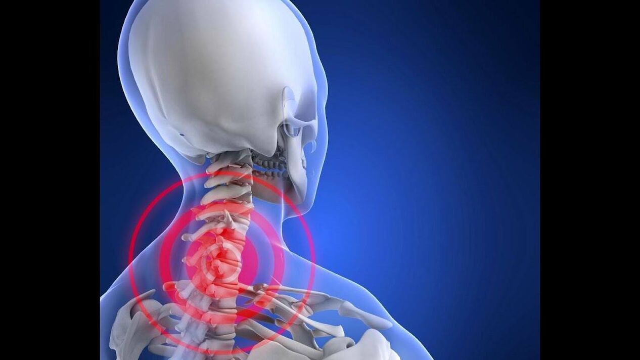 Osteochondrosis ng cervical spine